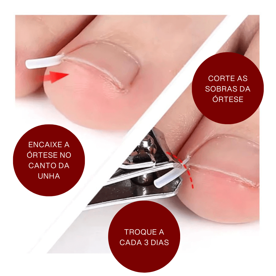 Tira de correção para unha dos pés- Corretor Podal